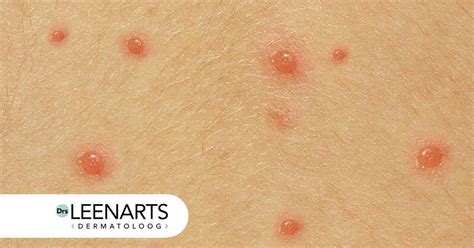 illustratie van waterpokken blaasjes op de huid