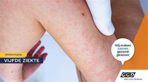 illustratie van de kenmerkende 'vlinder' uitslag bij de vijfde ziekte