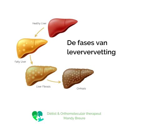Illustratie van de lever van een koe en de effecten van vervetting