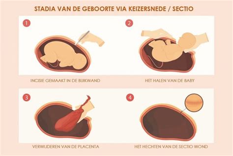schematische weergave van de buikwond na een keizersnede en de genezingsfasen