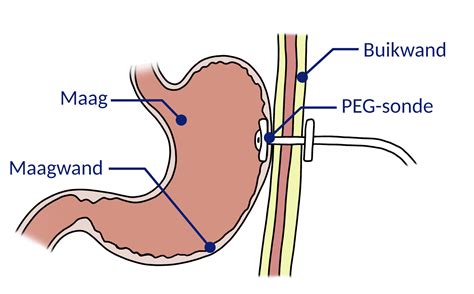 Illustratie van verschillende methoden van bijvoeding: sonde aan de borst, vingervoeding, flesvoeding.