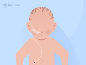 Illustratie van sondevoeding bij een pasgeboren baby.