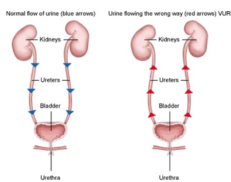 Schematische weergave van een baby met blaasextrofie, met de blaas buiten de buik zichtbaar.