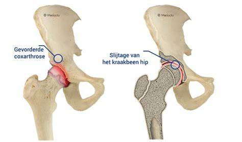 Schema van een bekkenkanteling (TPO/DPO) waarbij de heupkom wordt gedraaid om de aansluiting met de heupkop te verbeteren.
