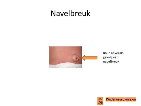 schematische weergave van een navelbreuk met beknelling