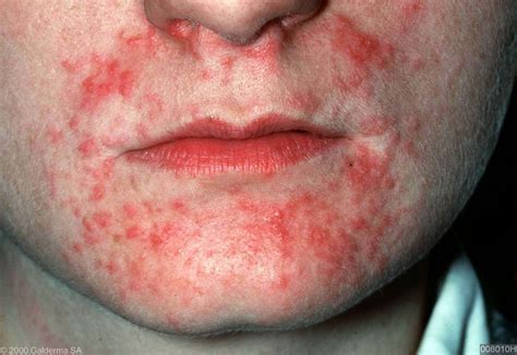 Illustratie van dermatitis perioralis, met rode bultjes en puistjes rond de mond, maar niet direct op de lippen.