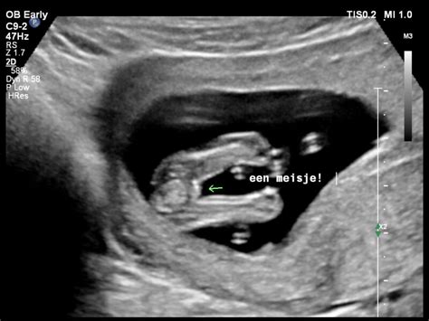 Beeld van een 13-weken echo