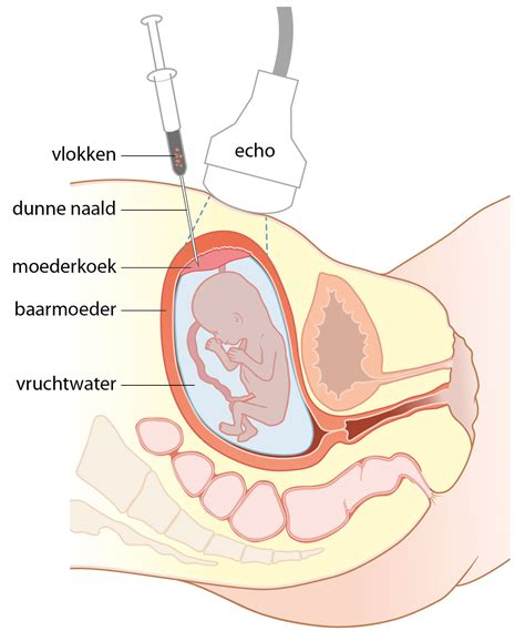 Schema dat de ethische dilemma's rondom prenatale diagnostiek en de rol van de arts weergeeft.