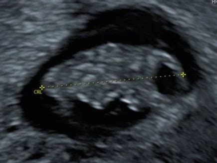 Illustratie van de nekplooimeting tijdens een vroege zwangerschapsecho