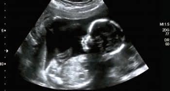 Een afbeelding van een gedetailleerde 20-wekenecho