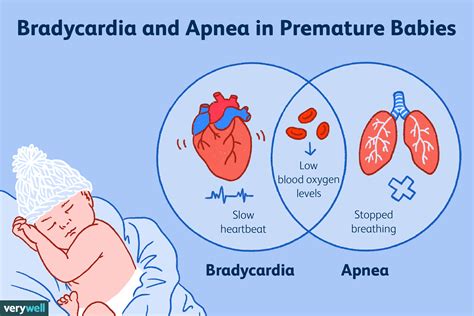 Infographic die het behandelproces van apneu bij premature baby's in het LUMC visualiseert, inclusief de rol van de BreatheBuddy.
