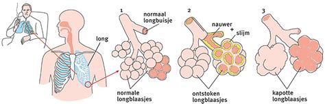 Illustratie van ontstoken longblaasjes en longbuisjes