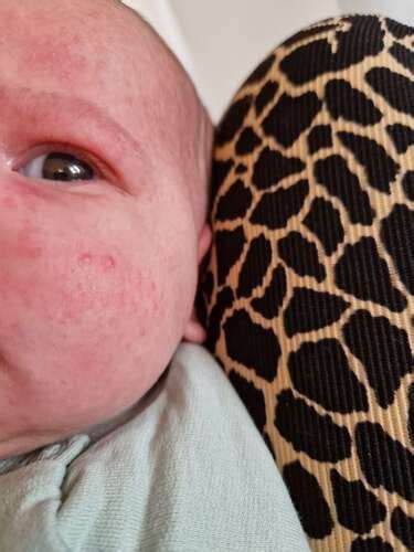 Illustratie van een baby met uitslag of spijsverteringsklachten die verband houden met koemelkallergie