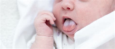 Illustratie van witte vlekjes in de mond van een baby, typisch voor spruw